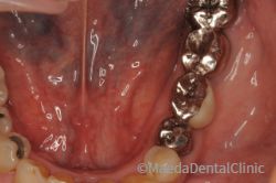 メタルブリッジ　金属