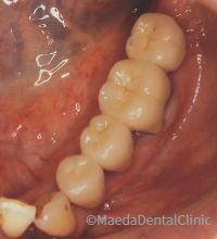 セラミックブリッジ