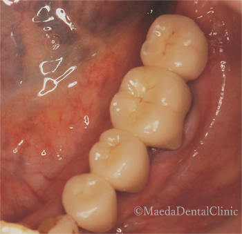 セラミックブリッジ