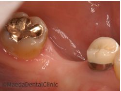 ブリッジ削る前