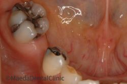 インプラント術前