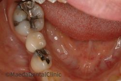 インプラント術後