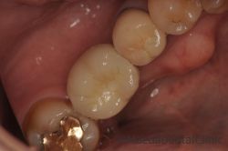 インプラント術後