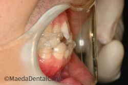 スリープスプリント装着