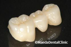 ハイトランスジルコニア