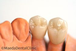 オールセラミック