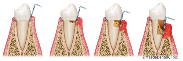 歯周病の進行