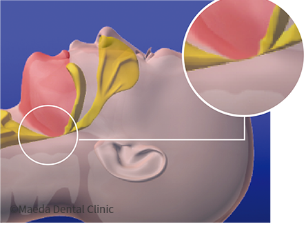睡眠時無呼吸症候群